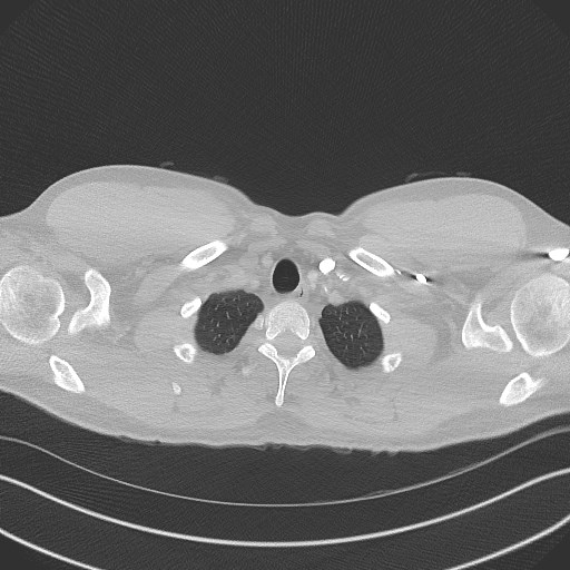 Bilateral atelectasis (Radiopaedia 48666-53675 Axial lung window 4).jpg