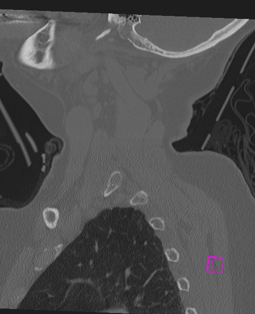 Bilateral atlanto-occipital assimilation (Radiopaedia 28350-28603 Sagittal bone window 14).jpg