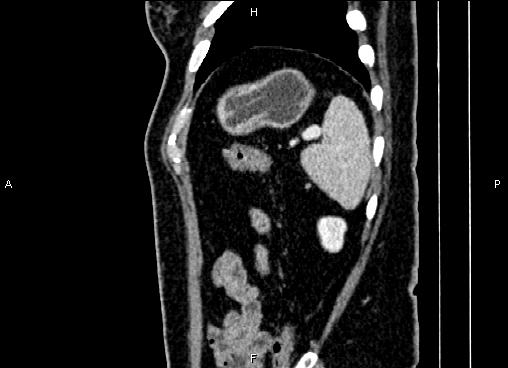 Bilateral benign adrenal adenomas (Radiopaedia 86912-103124 E 86).jpg