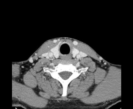 Bilateral carotid body tumors (Radiopaedia 61841-69870 Axial Post contrast 87).jpg