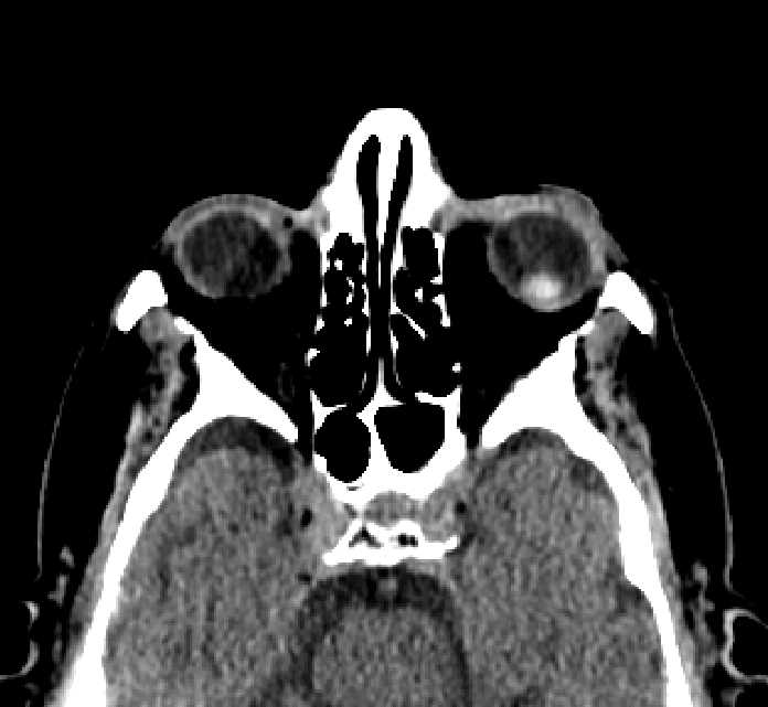 Bilateral ectopia lentis (Radiopaedia 89889-107013 Axial non-contrast 53).jpg