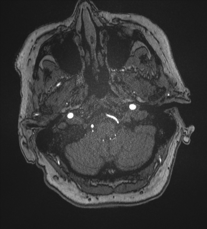Bilateral fetal posterior communicating arteries (Radiopaedia 41286-44102 Axial MRA 9).png