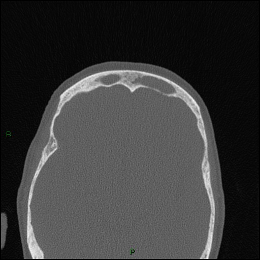 Bilateral frontal mucoceles (Radiopaedia 82352-96454 Axial bone window 89).jpg