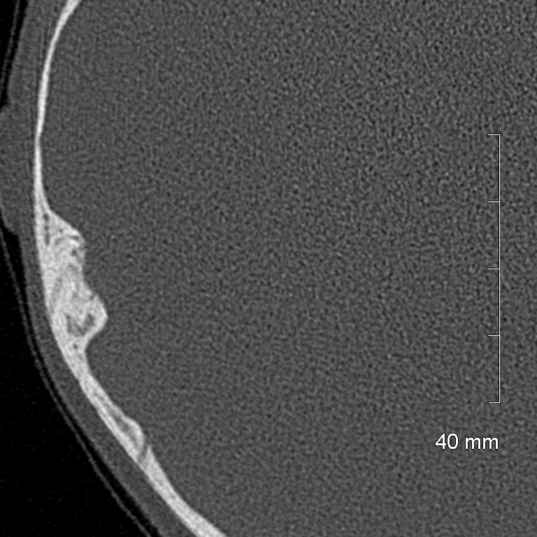 Bilateral grommets (Radiopaedia 47710-52404 Axial bone window 74).jpg