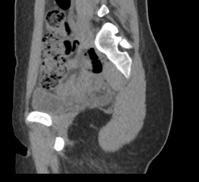 Bilateral mature cystic ovarian teratoma (Radiopaedia 88821-105592 D 15).jpg