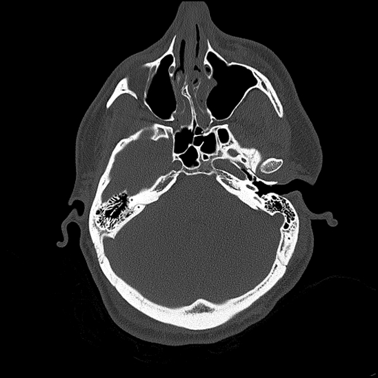 Bilateral occipital condyle fracture (type 2) (Radiopaedia 87675-104089 Axial bone thins 67).jpg