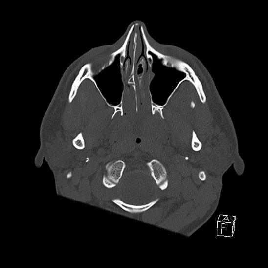 File:Bilateral occipital condyle fracture (type 2) (Radiopaedia 87675-104089 Axial bone window 6).jpg