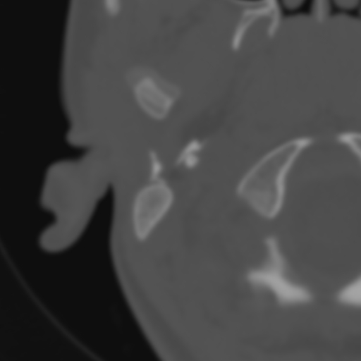 Bilateral otosclerosis (Radiopaedia 57237-64157 B 7).jpg