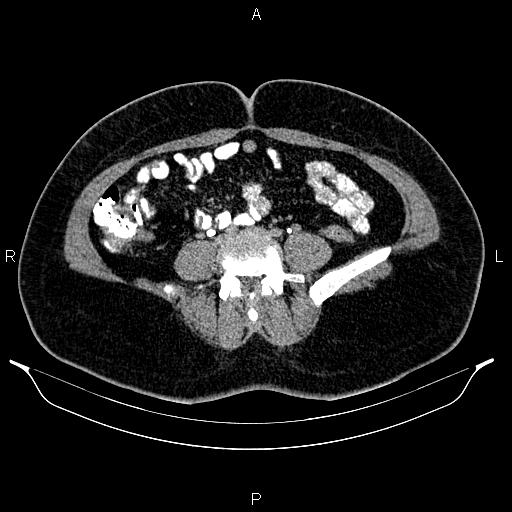 Bilateral ovarian dermoid cysts (Radiopaedia 85785-101603 Axial C+ delayed 49).jpg