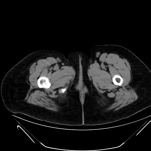 Bilateral ovarian mature cystic teratomas (Radiopaedia 79373-92457 Axial non-contrast 110).jpg