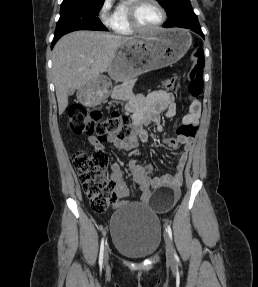 Bilateral ovarian mature cystic teratomas (Radiopaedia 79373-92457 B 15).jpg
