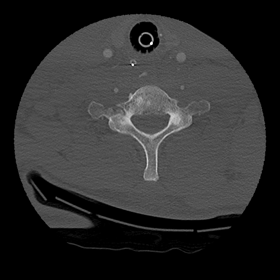 Bilateral perched facets with cord injury (Radiopaedia 45587-49713 Axial bone window 84).jpg