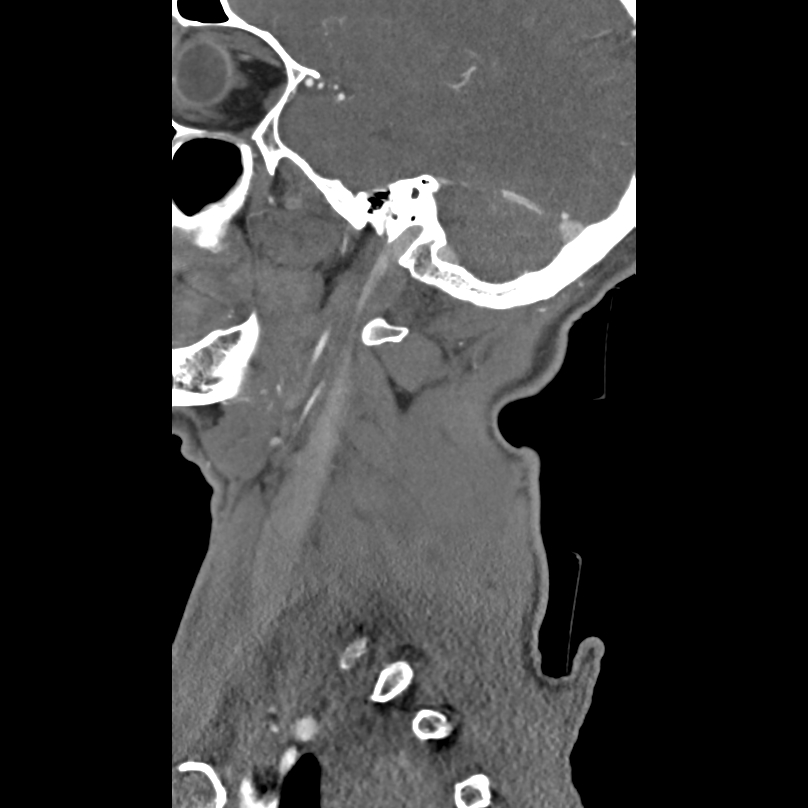 Bilateral perched facets with cord injury (Radiopaedia 45587-49713 B 6).jpg