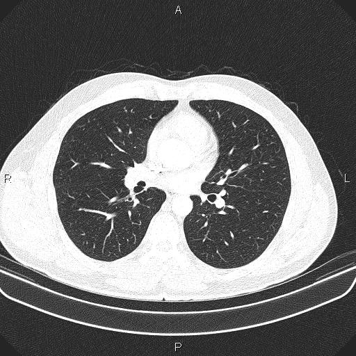 File:Bilateral pulmonary AVM (Radiopaedia 83134-97505 Axial lung window 38).jpg