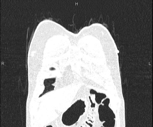Bilateral pulmonary AVM (Radiopaedia 83134-97505 Coronal lung window 15).jpg