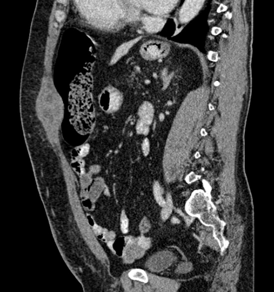 Bilateral rectus sheath hematomas (Radiopaedia 50778-56252 B 49).jpg