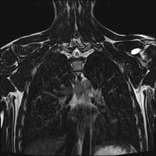 Bilateral spinoglenoid notch ganglion cysts (Radiopaedia 29577-30082 Coronal T2 84).jpg