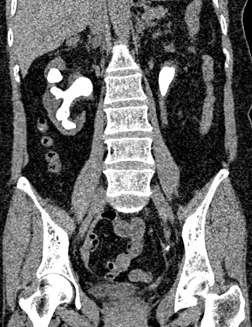 Bilateral staghorn calculi (Radiopaedia 59475-66842 Coronal non-contrast 63).jpg