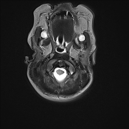 File:Bilateral subdural hemorrhage and parietal skull fracture (Radiopaedia 26058-26190 Axial T2 1).png