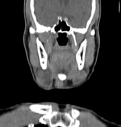 Bilateral submandibular sialolithiasis with sialadenitis (Radiopaedia 70721-80881 Coronal non-contrast 26).jpg