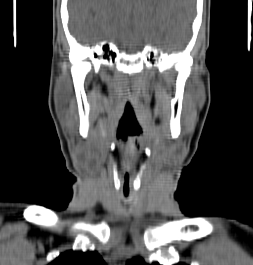 Bilateral submandibular sialolithiasis with sialadenitis (Radiopaedia 70721-80881 Coronal non-contrast 58).jpg
