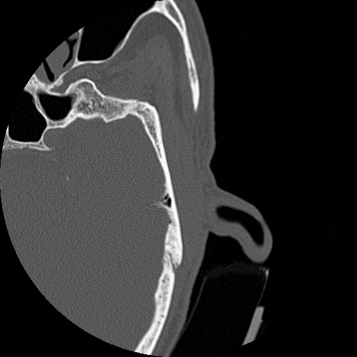 File:Bilateral temporal bone fractures (Radiopaedia 29482-29970 D 112).jpg