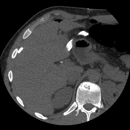 File:Bile leak from liver traumatic laceration (Radiopaedia 63463-72077 Axial Biliscopin 38).jpg
