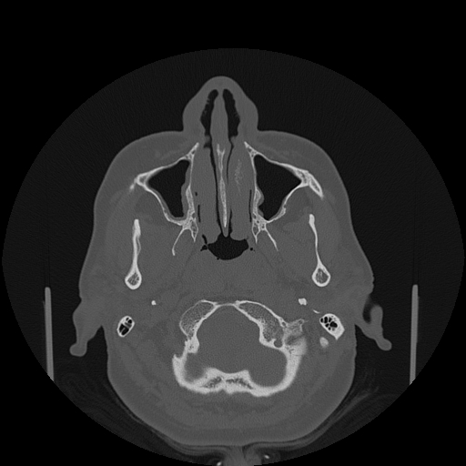 File:Bisphosphonate-related osteonecrosis of the jaw (Radiopaedia 71324-81642 Axial bone window 130).jpg