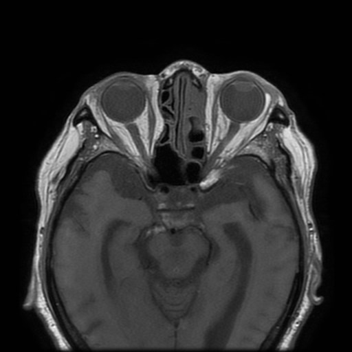 Bisphosphonate-related osteonecrosis of the maxilla (Radiopaedia 51367-57101 Axial T1 40).jpg