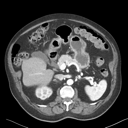 File:Bladder papillary urothelial carcinoma (Radiopaedia 48119-52951 A 15).png