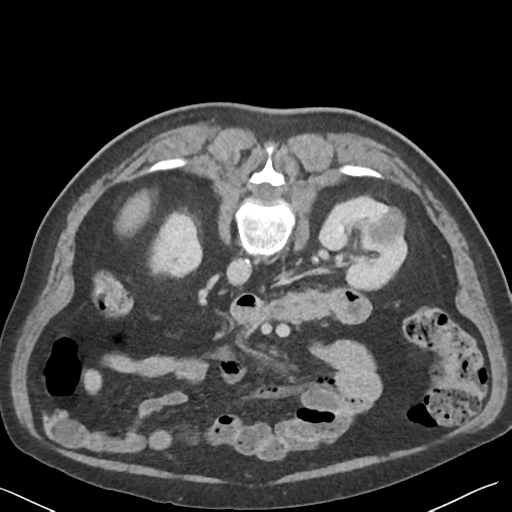 File:Bladder papillary urothelial carcinoma (Radiopaedia 48119-52951 Axial C+ delayed 17).png