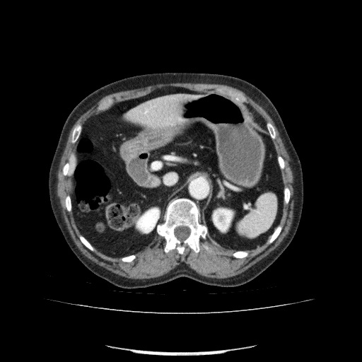 File:Bladder tumor detected on trauma CT (Radiopaedia 51809-57609 B 40).jpg
