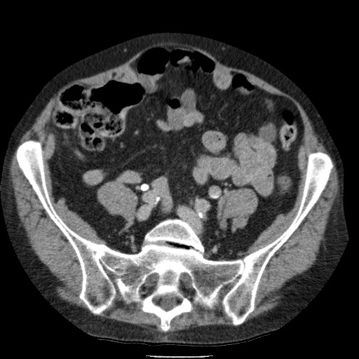 Bladder tumor detected on trauma CT (Radiopaedia 51809-57609 C 96).jpg