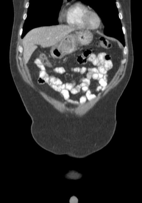 Bleeding duodenal ulcer and adenomyomatosis of gallbladder (Radiopaedia 61834-69861 B 69).jpg
