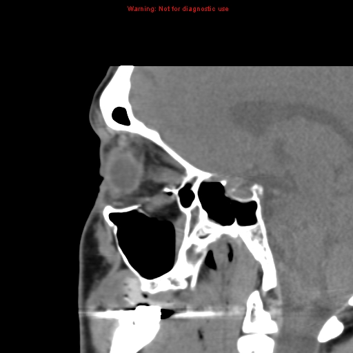 File:Blowout fracture with inferior rectus entrapment (Radiopaedia 12418-12673 C 13).jpg