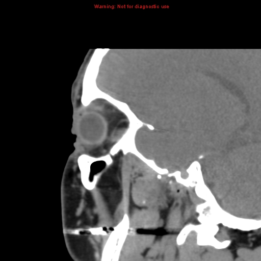 File:Blowout fracture with inferior rectus entrapment (Radiopaedia 12418-12673 C 5).jpg