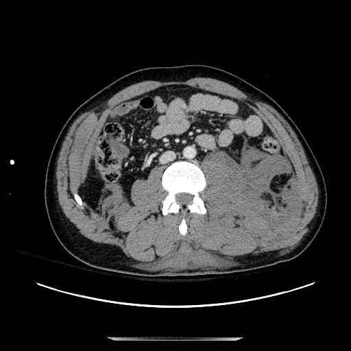 Blunt abdominal trauma with solid organ and musculoskelatal injury with active extravasation (Radiopaedia 68364-77895 A 80).jpg