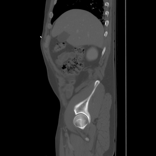 File:Blunt abdominal trauma with solid organ and musculoskelatal injury with active extravasation (Radiopaedia 68364-77895 Sagittal bone window 16).jpg