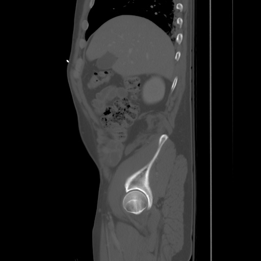 Blunt abdominal trauma with solid organ and musculoskelatal injury with active extravasation (Radiopaedia 68364-77895 Sagittal bone window 17).jpg