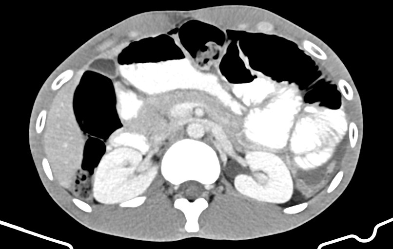 Blunt injury to the small bowel (Radiopaedia 74953-85987 A 51).jpg