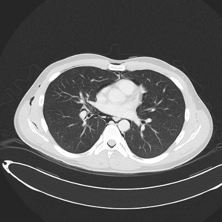 Boerhaave syndrome with mediastinal, axillary, neck and epidural free gas (Radiopaedia 41297-44115 Axial lung window 53).jpg