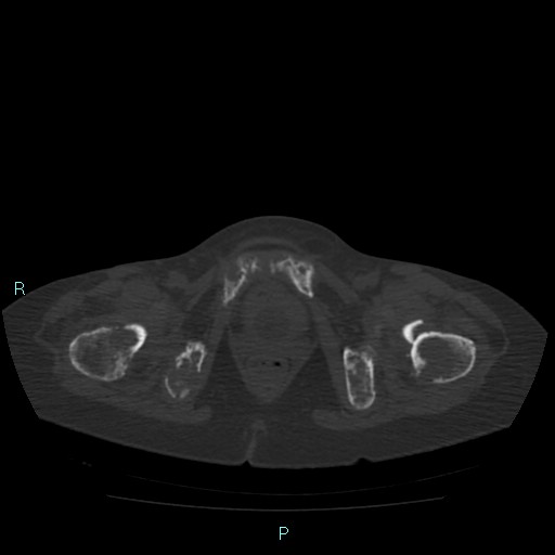 Bone metastases from untreated breast cancer (Radiopaedia 42973-46219 Axial bone window 194).jpg