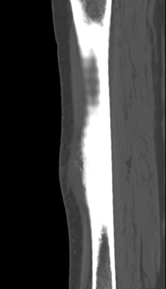Bone metastasis - tibia (Radiopaedia 57665-64609 Sagittal bone window 105).jpg