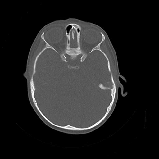 File:Bony atresia of the right external auditory canal (Radiopaedia 27916-28156 Axial bone window 12).jpg