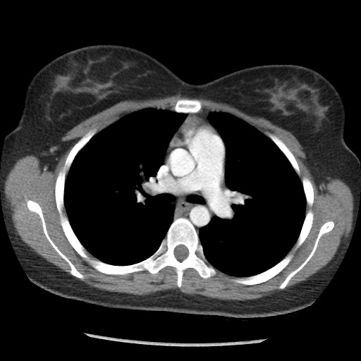 File:Borderline mucinous tumor (ovary) (Radiopaedia 78228-90808 A 20).jpg