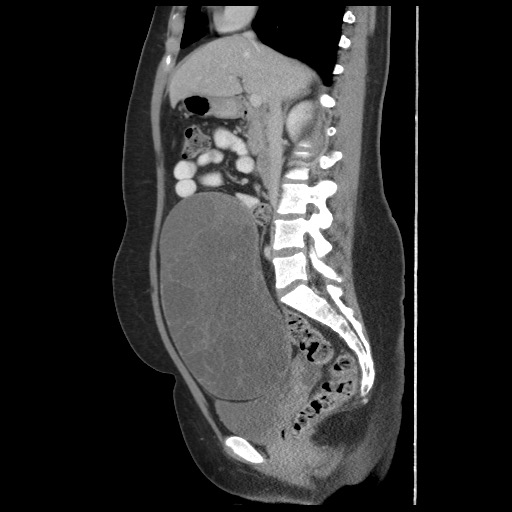 File:Borderline mucinous tumor (ovary) (Radiopaedia 78228-90808 B 32).jpg