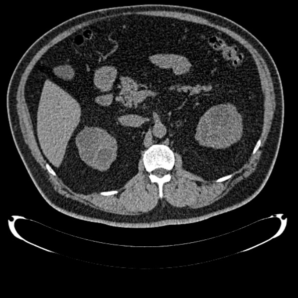 Bosniak renal cyst - type IV (Radiopaedia 24244-24518 Axial non-contrast 131).jpg