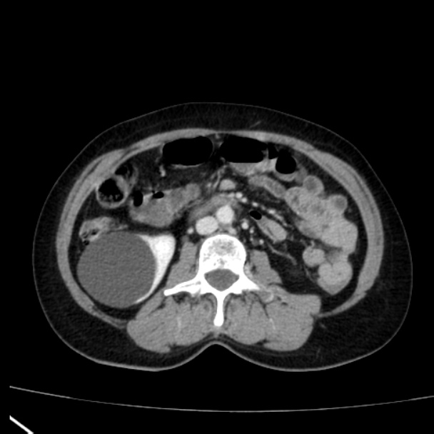 Bosniak renal cyst - type I (Radiopaedia 27479-27675 C 44).jpg