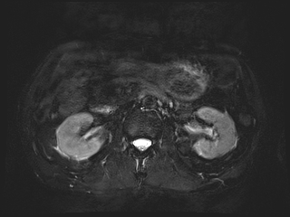 File:Bouveret syndrome (Radiopaedia 61017-68856 Axial MRCP 34).jpg