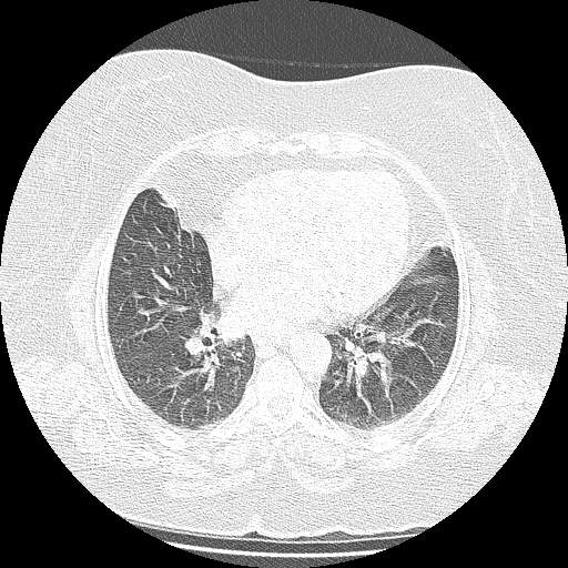 Bovine aortic arch - right internal mammary vein drains into the superior vena cava (Radiopaedia 63296-71875 Axial lung window 100).jpg
